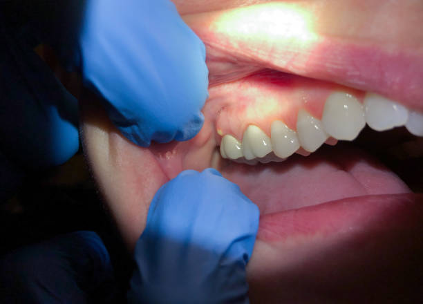 Best Emergency Treatment for Oral Infections in Vivian, LA